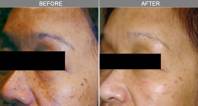 laser mole removal face